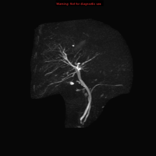File:Biliary tree anatomical variant - biliary trifurcation (Radiopaedia 12531-12750 Coronal 3D MRCP 11).jpg