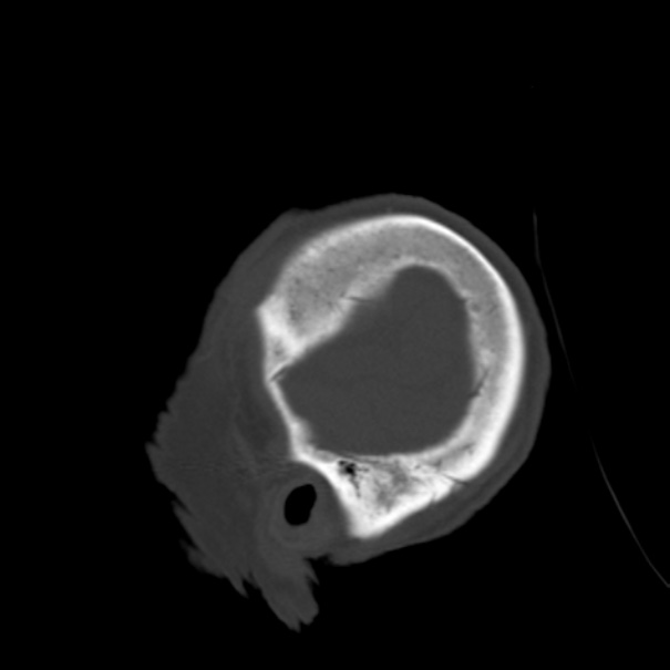 Biparietal osteodystrophy (Radiopaedia 46109-50463 Sagittal bone window 11).jpg