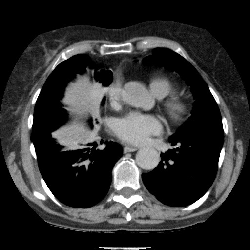 Bladder tumor detected on trauma CT (Radiopaedia 51809-57609 C 5).jpg