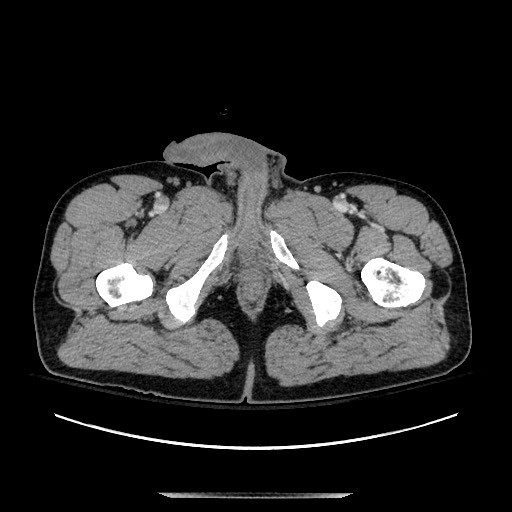 Blunt abdominal trauma with solid organ and musculoskelatal injury with active extravasation (Radiopaedia 68364-77895 A 169).jpg