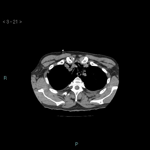 Boerhaave syndrome (Radiopaedia 27683-27897 Axial non-contrast 21).jpg