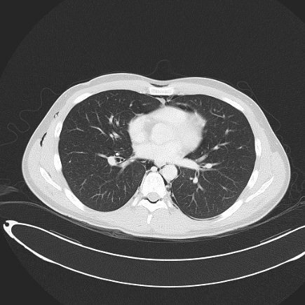 File:Boerhaave syndrome with mediastinal, axillary, neck and epidural free gas (Radiopaedia 41297-44115 Axial lung window 55).jpg
