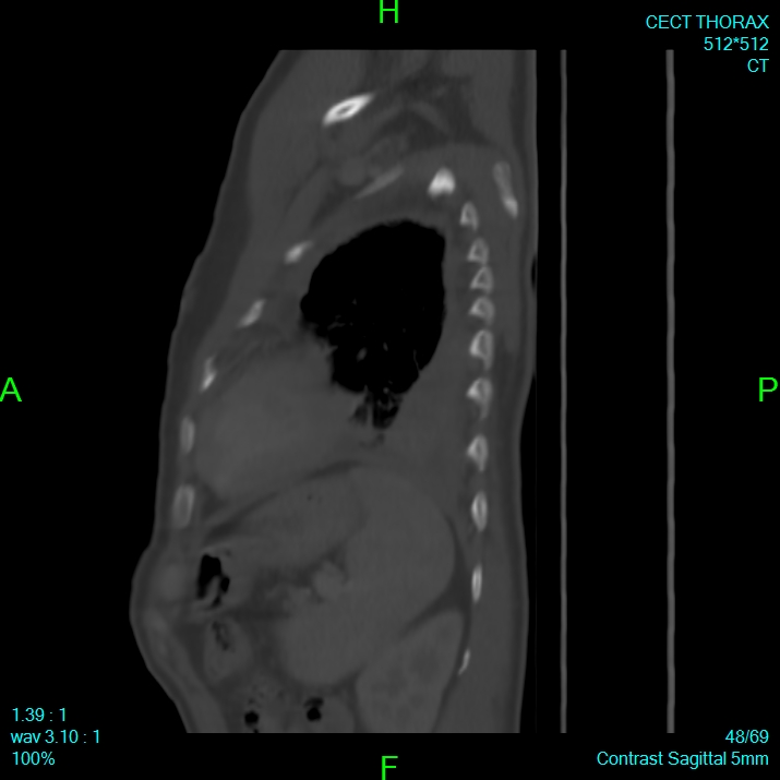 Bone metastases from lung carcinoma (Radiopaedia 54703-60937 Sagittal bone window 48).jpg