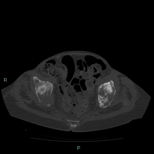 Bone metastases from untreated breast cancer (Radiopaedia 42973-46219 Axial bone window 176).jpg