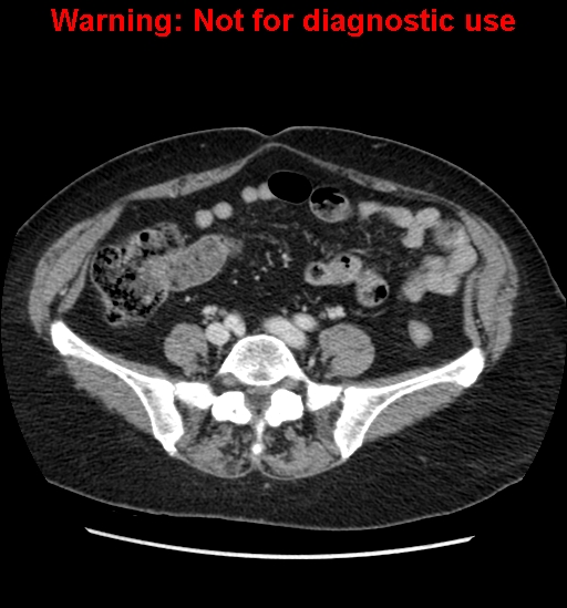 File:Bosniak renal cyst - type II (Radiopaedia 23404-23468 D 48).jpg
