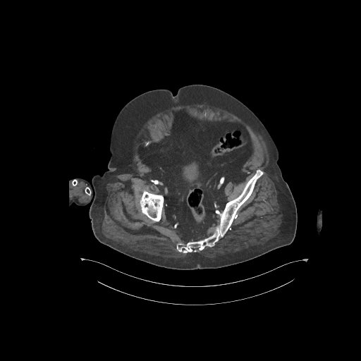 File:Bowel ischemia secondary to SMA occlusion with extensive portomesenteric venous gas (Radiopaedia 54656-60871 A 4).jpg