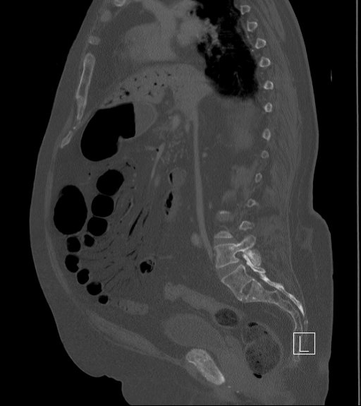 File:Bowel ischemia secondary to SMA occlusion with extensive portomesenteric venous gas (Radiopaedia 54656-60871 Sagittal bone window 60).jpg