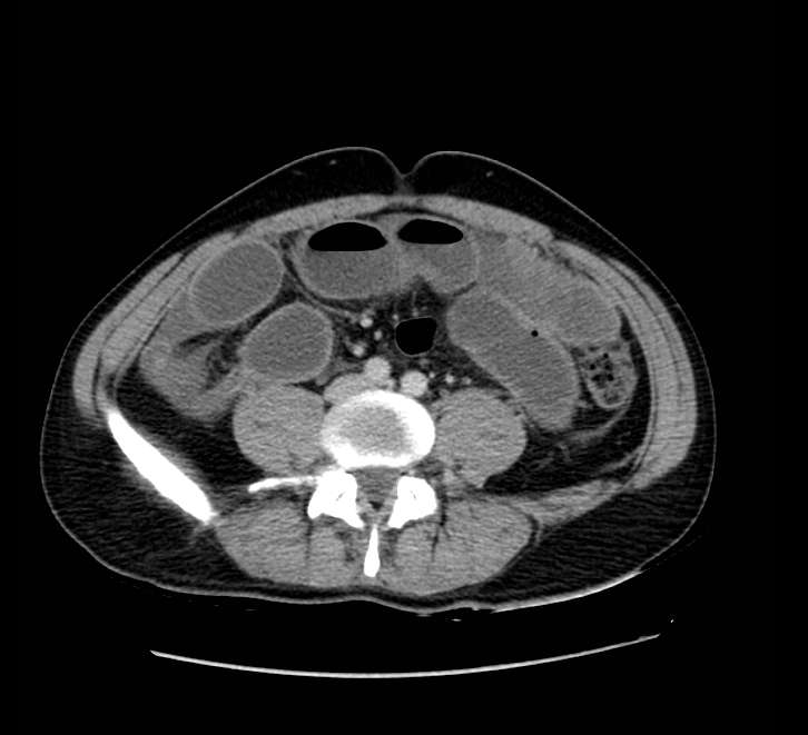 Bowel obstruction from colon carcinoma (Radiopaedia 22995-23028 A 54).jpg