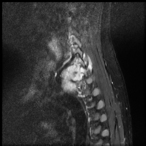 File:Brachial plexus neurofibroma (Radiopaedia 28030-28291 Sagittal STIR 3).png