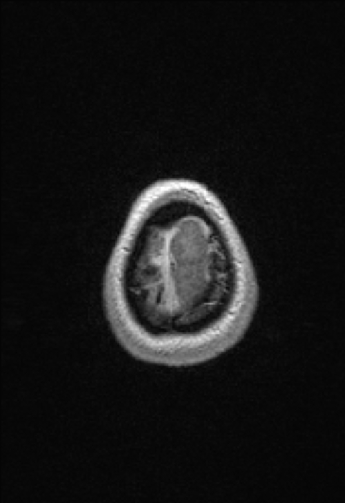 Brain abscess with ventriculitis (Radiopaedia 85703-101495 Axial T1 C+ 158).jpg