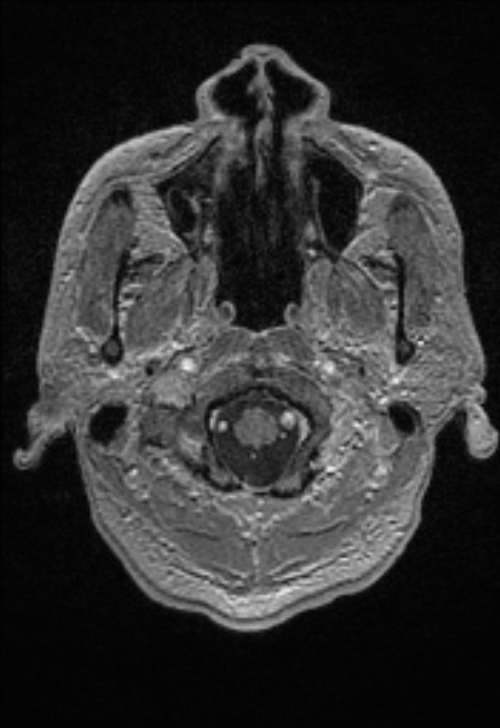 Brain abscess with ventriculitis (Radiopaedia 85703-101495 Axial T1 C+ 20).jpg