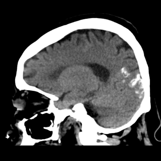 Brain cortical laminar necrosis (Radiopaedia 25822-25971 non-contrast 20).jpg