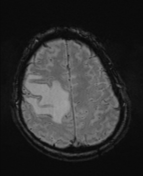 Brain metastases - lung cancer primary (Radiopaedia 75060-86115 Axial SWI 48).jpg