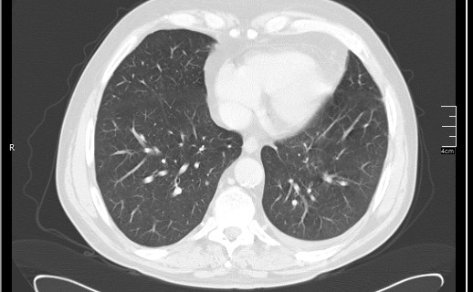 Brain metastases from squamocellular lung cancer (Radiopaedia 56515-63219 Axial lung window 47).jpg