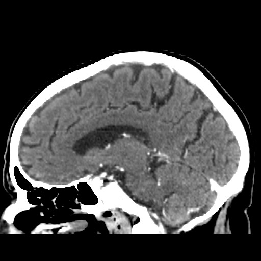 Brain metastasis (Radiopaedia 42617-45760 D 23).jpg