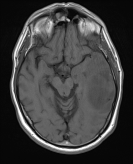 File:Brain metastasis (large cystic mass) (Radiopaedia 47497-52107 Axial T1 11).png