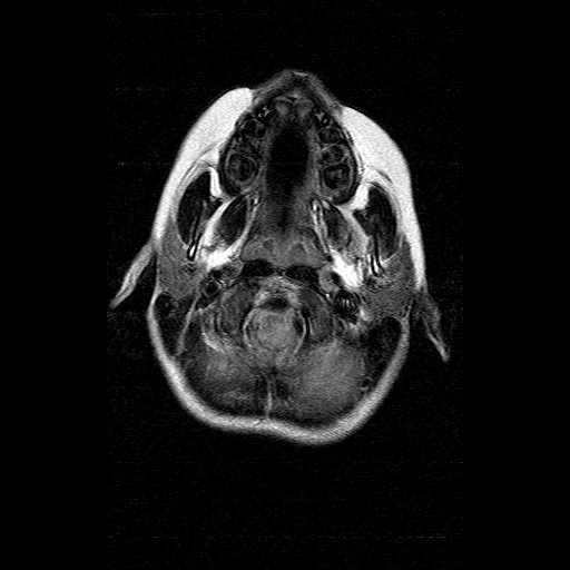 File:Brainstem ganglioglioma (Radiopaedia 10763-11224 Axial FLAIR 18).jpg