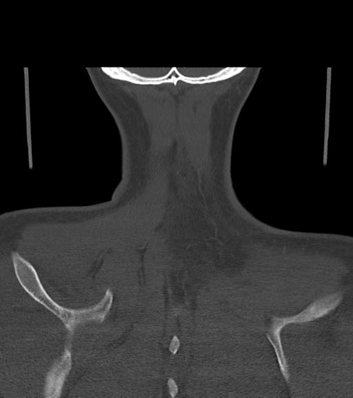 File:Branchial cleft cyst (Radiopaedia 31167-31875 Coronal bone window 60).jpg