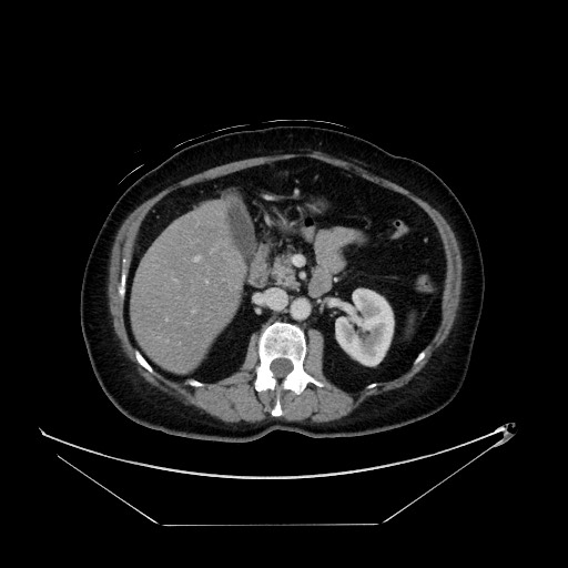 File:Breast cancer pseudocirrhosis with lobar invovlement (Radiopaedia 81080-94670 A 67).jpg