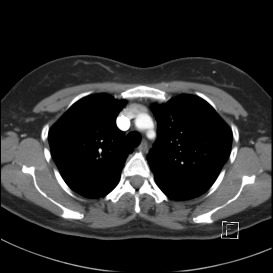 File:Breast metastases from renal cell cancer (Radiopaedia 79220-92225 A 26).jpg
