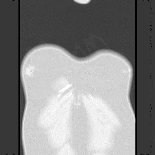 Bronchial carcinoid tumor (Radiopaedia 67377-76764 Coronal lung window 13).jpg