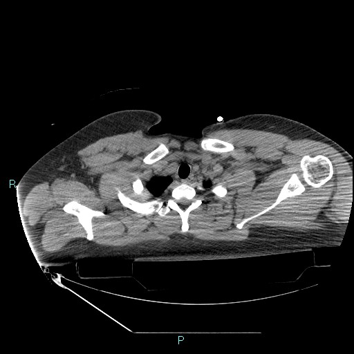 File:Bronchial carcinoid tumor (Radiopaedia 78272-90870 Axial non-contrast 10).jpg