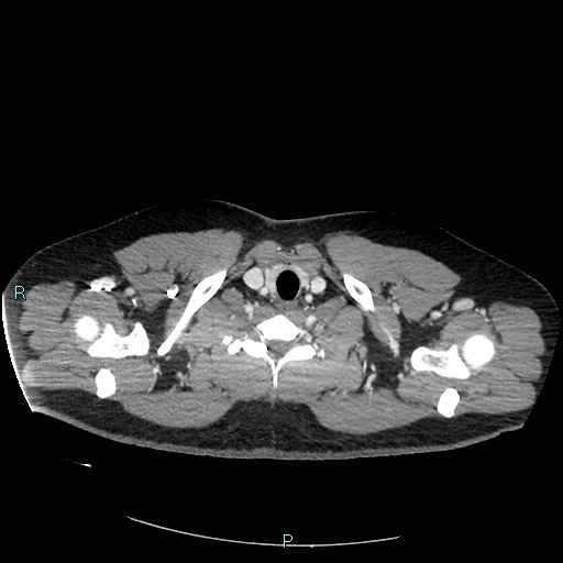Bronchial carcinoid tumor (Radiopaedia 78272-90875 A 11).jpg