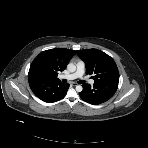 Bronchial carcinoid tumor (Radiopaedia 78272-90875 A 46).jpg