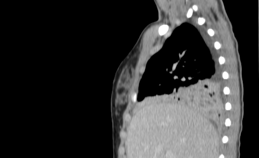 Bronchial mucoepidermoid carcinoma (Radiopaedia 57023-63895 Sagittal 52).jpg