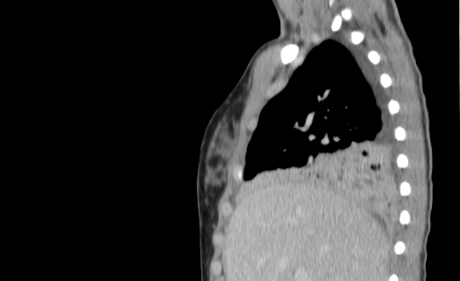 Bronchial mucoepidermoid carcinoma (Radiopaedia 57023-63895 Sagittal 53).jpg