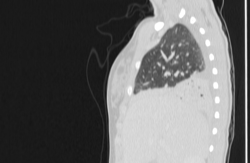 Bronchial mucoepidermoid carcinoma (Radiopaedia 57023-63895 Sagittal lung window 16).jpg