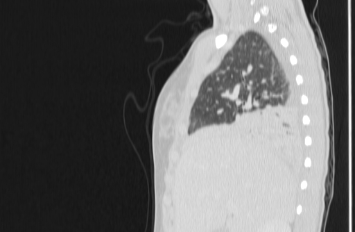 Bronchial mucoepidermoid carcinoma (Radiopaedia 57023-63895 Sagittal lung window 23).jpg
