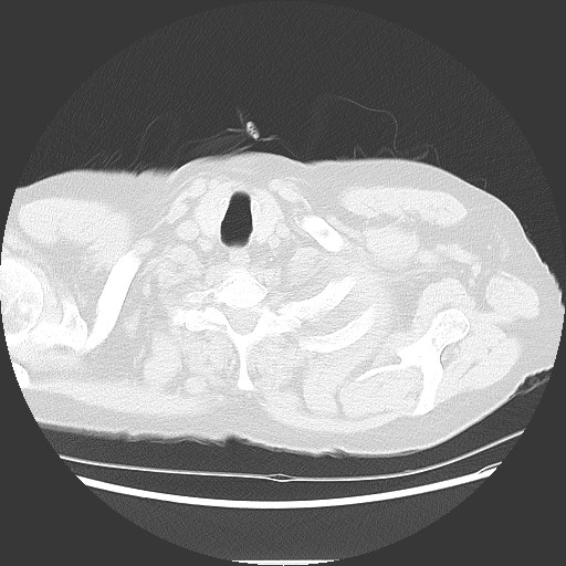 Bronchial stenosis - lung transplant (Radiopaedia 73133-83848 Axial lung window 4).jpg