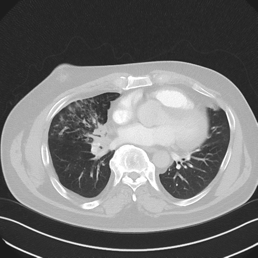 Bronchiectasis (Radiopaedia 39385-41666 Axial lung window 38).png