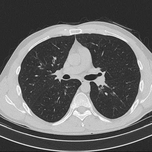 Bronchocele (Radiopaedia 60676-68429 Axial lung window 32).jpg