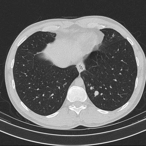Bronchocele (Radiopaedia 60676-68429 Axial lung window 58).jpg