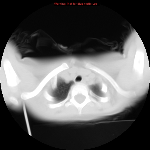 File:Bronchogenic cyst (Radiopaedia 9372-10063 Axial lung window 2).jpg