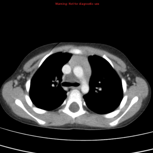 File:Bronchogenic cyst (Radiopaedia 9372-10063 C 5).jpg
