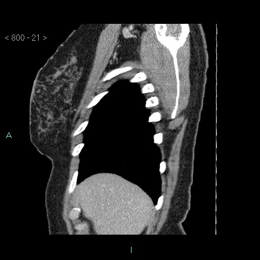 Bronchogenic cyst - posterior mediastinal (Radiopaedia 43885-47364 B 14).jpg
