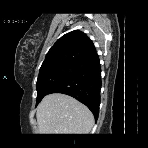 File:Bronchogenic cyst - posterior mediastinal (Radiopaedia 43885-47364 B 19).jpg