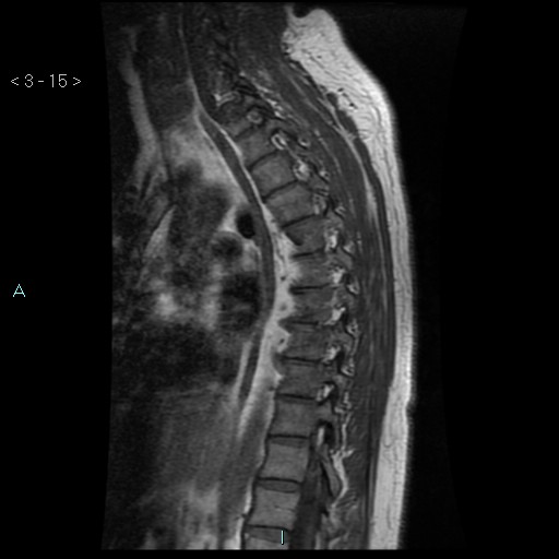 File:Bronchogenic cyst - posterior mediastinal (Radiopaedia 43885-47365 Sagittal T1 15).jpg