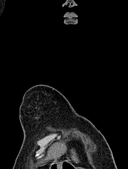 Bronchus suis (Radiopaedia 39631-41953 Coronal non-contrast 6).jpg