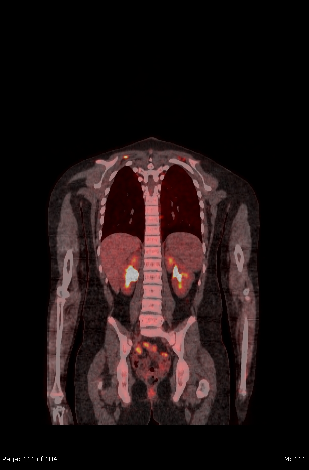 Brown fat uptake (FDG PET-CT) (Radiopaedia 77392-89513 Fused coronal 69).jpg