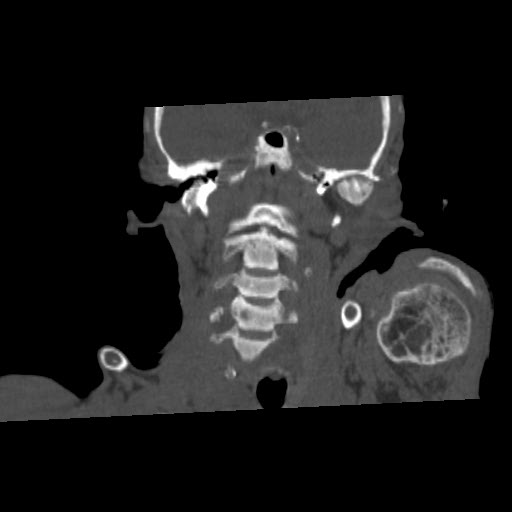 File:Brown tumor with secondary hyperparathyroidism (Radiopaedia 23591-23705 bone window 17).jpg