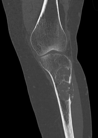 File:Brown tumors (Radiopaedia 9666-10291 Sagittal bone window 1).jpg