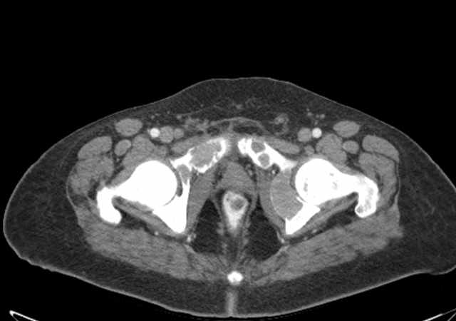 File:Brown tumors compressing the spinal cord (Radiopaedia 68442-77988 E 123).jpg