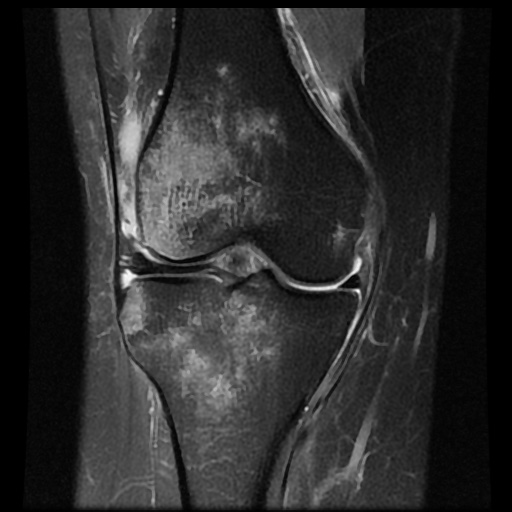 File:Bucket handle meniscus tear (Radiopaedia 56916-63751 Coronal PD fat sat 10).jpg