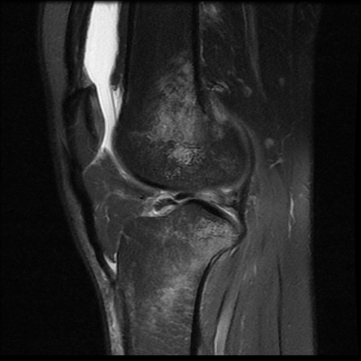 File:Bucket handle meniscus tear (Radiopaedia 56916-63751 Sagittal PD fat sat 8).jpg