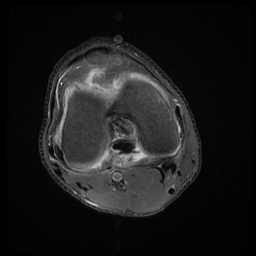 File:Bucket handle tear - medial meniscus (Radiopaedia 69245-79026 Axial PD fat sat 11).jpg