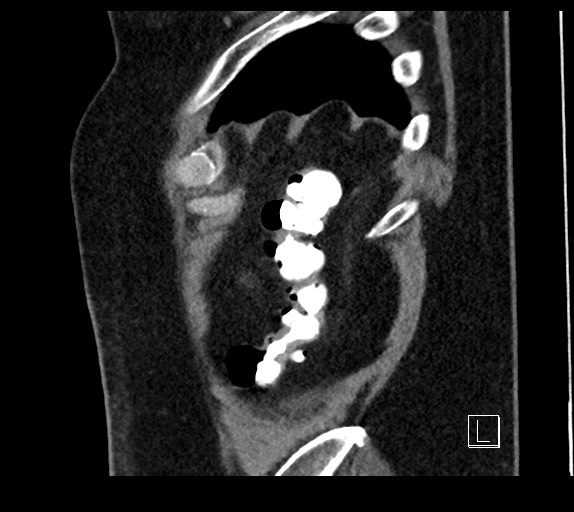 Buried bumper syndrome - gastrostomy tube (Radiopaedia 63843-72577 Sagittal Inject 11).jpg